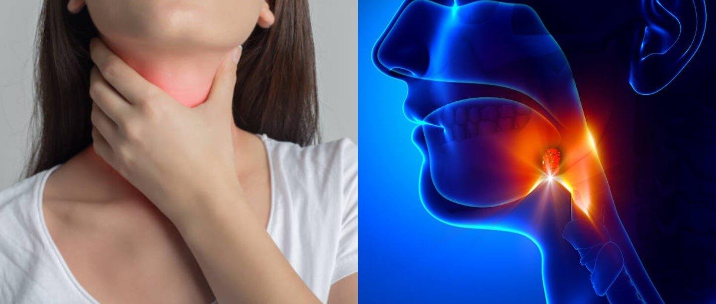 Tonsil in Hindi - Tonsils ka Ilaj - टॉन्सिल होने के कारण, लक्षण और घरेलू उपचार