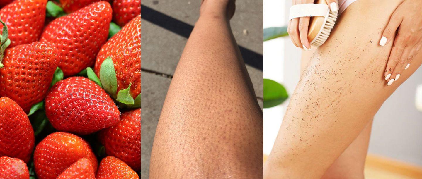How to Get Rid of Strawberry Legs at Home tips in Hindi, How to Get Rid of Strawberry Legs, Strawberry Legs