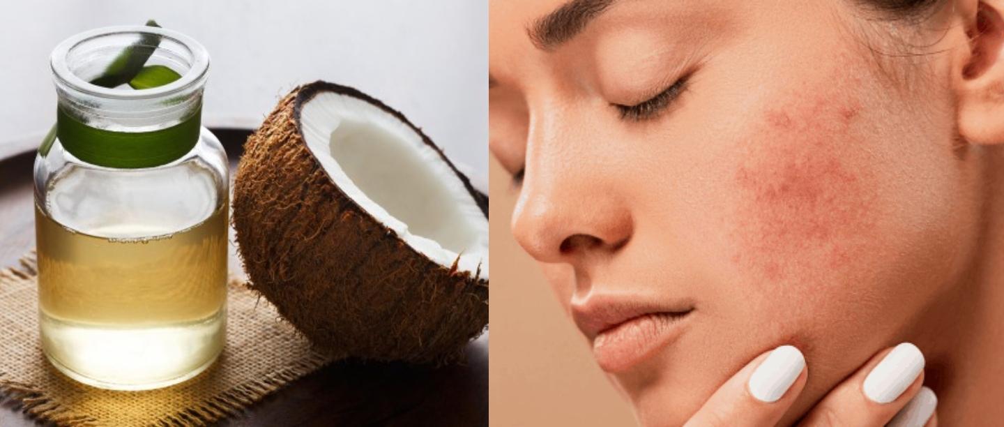 ज्यादा नारियल तेल भी चेहरे पर लगाने से हो सकती हैं आपको ये स्किन प्रॉब्लम्स