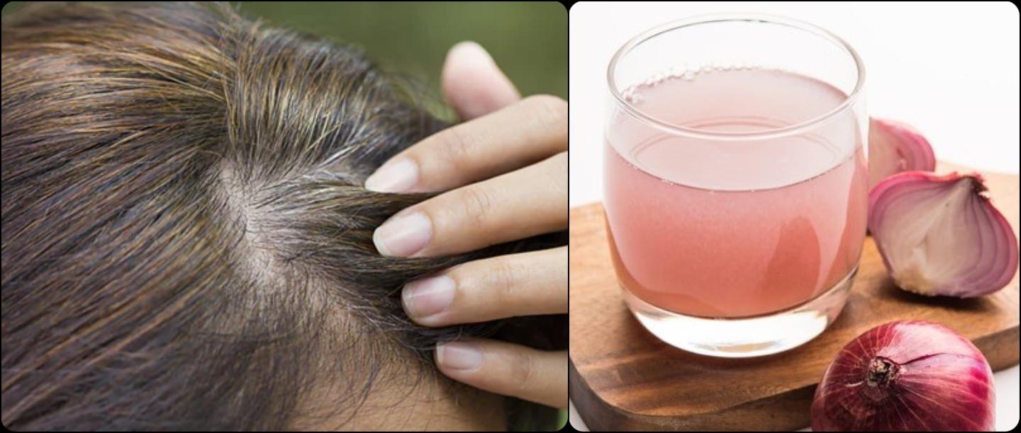 सफेद बालों को काला करने के लिए प्याज का नुस्खा, How to Use of Onion Juice for Grey Hair DIY in Hindi