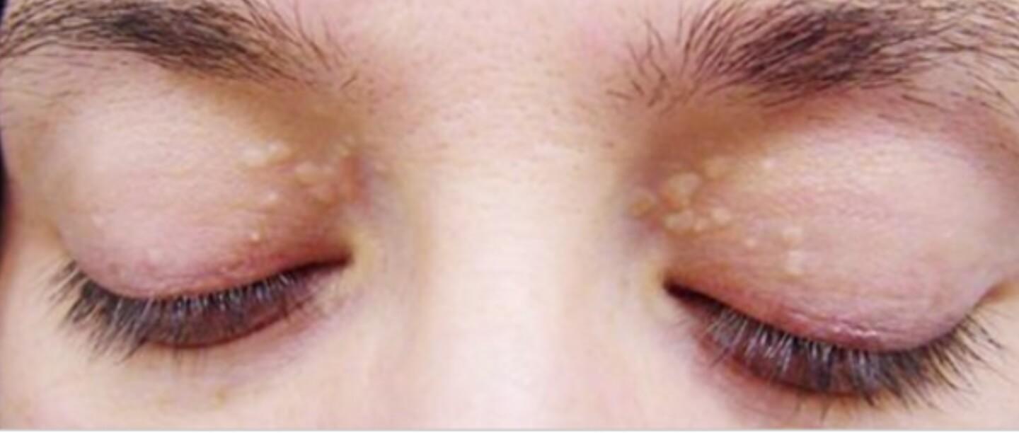 आंखों के पास जमा हुए कोलेस्ट्रॉल के निशान को कैसे दूर करें? जानें क्या है इसका सही इलाज