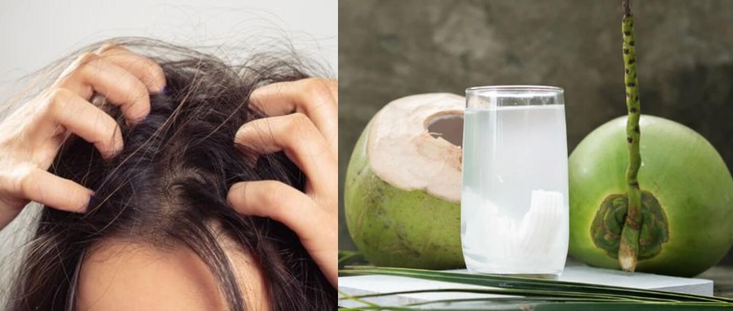 नारियल पानी से पाएं डैंड्रफ और रूखे बालों की समस्या से छुटकारा, जानिए कैसे करें इस्तेमाल